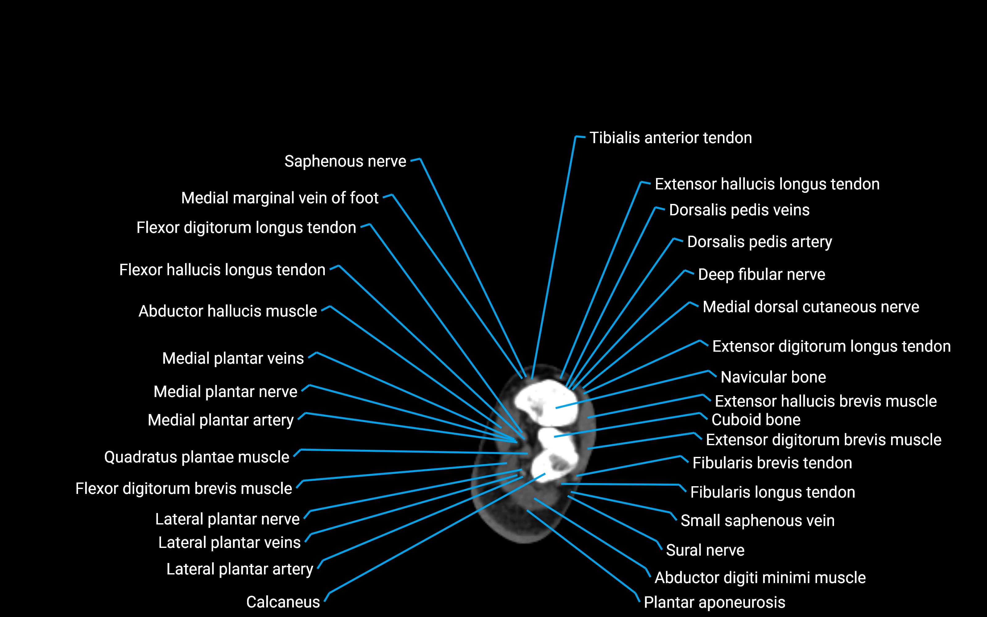 CT Lower leg axial cross sectional anatomy labelled image 176 (2).png